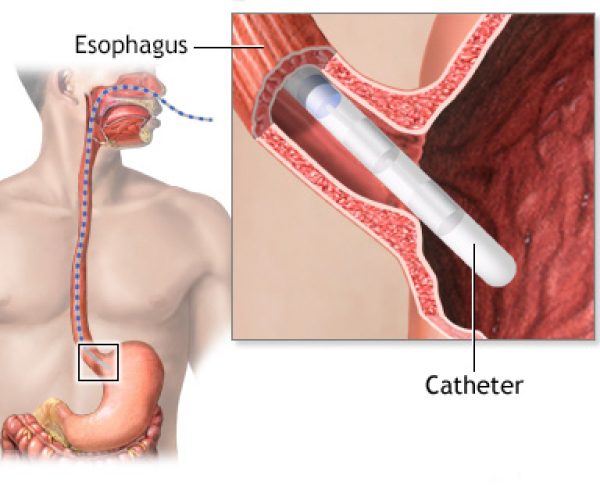 Esophageal Manometry