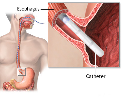 Esophageal manometry