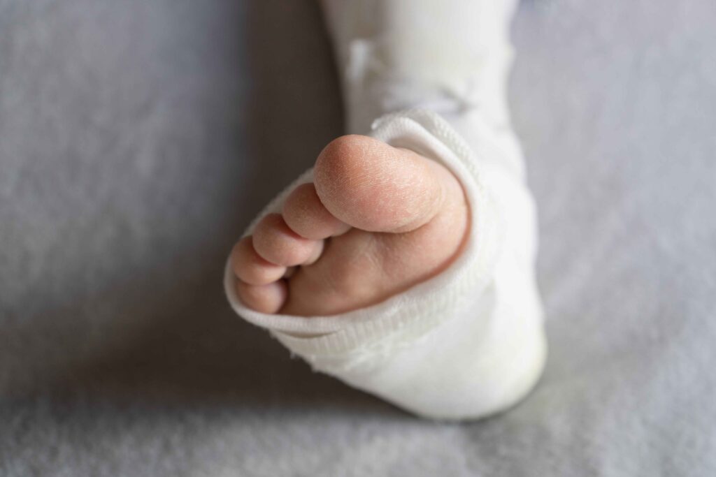 Achilles tendon repair 1 : surgical repair or reconstruction of a torn or degenerated achilles tendon.