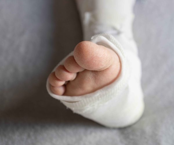 Achilles Tendon Repair Achilles Tendon Repair