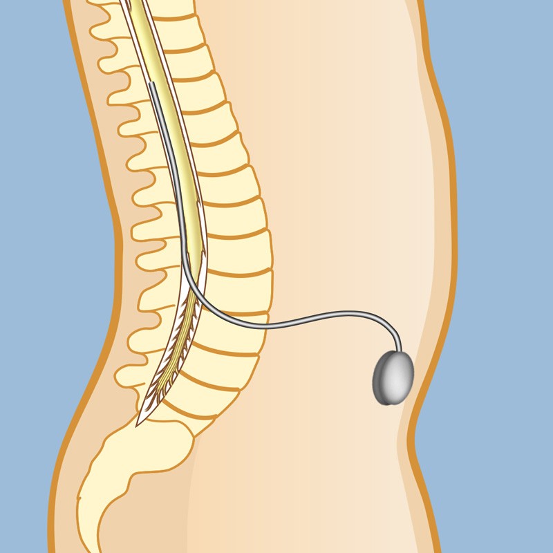 Intrathecal drug delivery (pain pumps) 1 Intrathecal drug delivery (pain pumps)