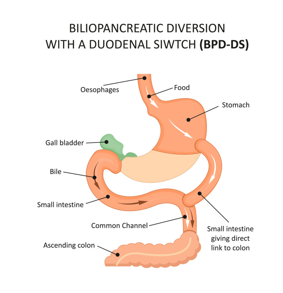 (bpd/ds surgery) biliopancreatic diversion with duodenal switch 1 Bpd/ds surgery
