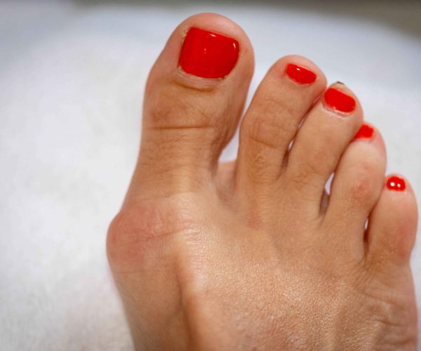 Surgical correction of hallux valgus deformity of the big toe