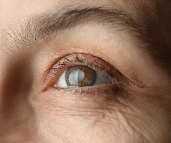 Cataract Surgery Cataract Surgery