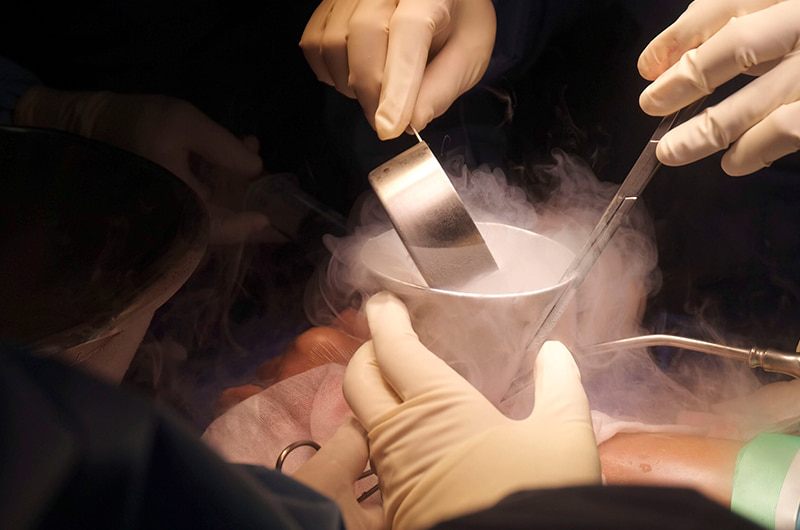 Cryosurgery