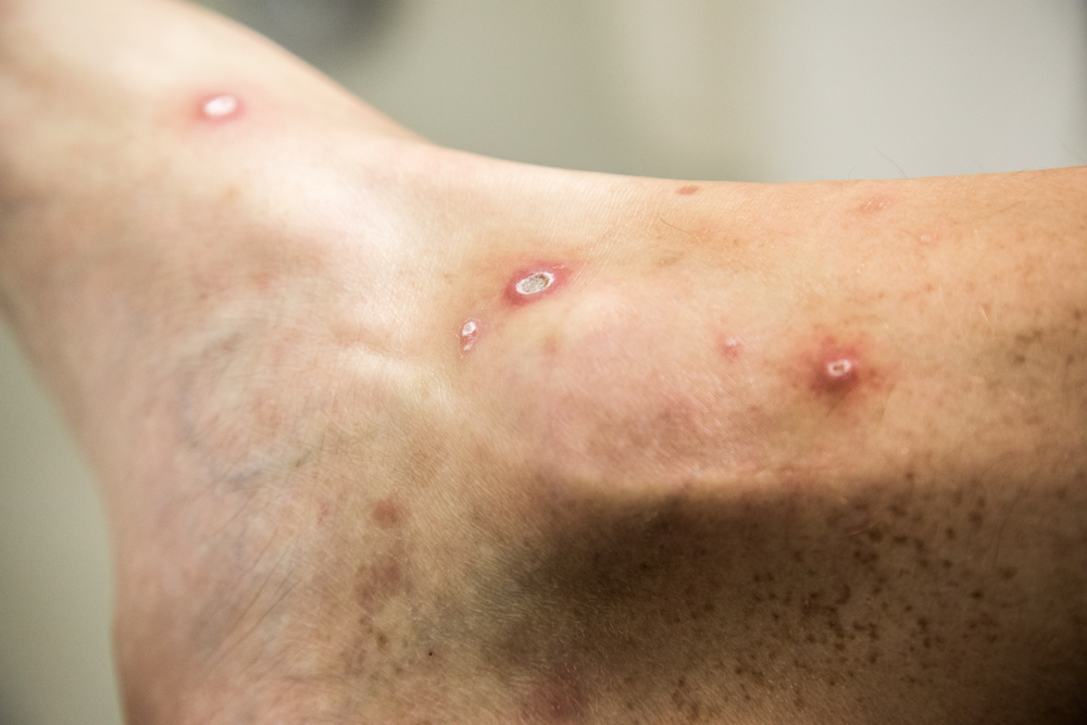 Diabetes can weaken your immune system. Learn how it increases your risk of staph infections and how to prevent serious complications.