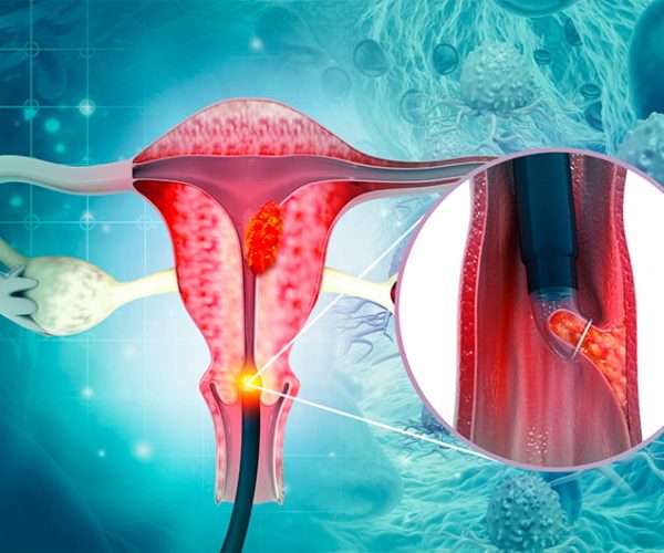 Endometrial Biopsy Endometrial-Biopsy-scaled