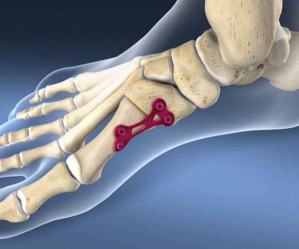 Foot-Bone-Fusion-(Arthrodesis) Permanent joining of bones to stabilize painful or arthritic foot joints.