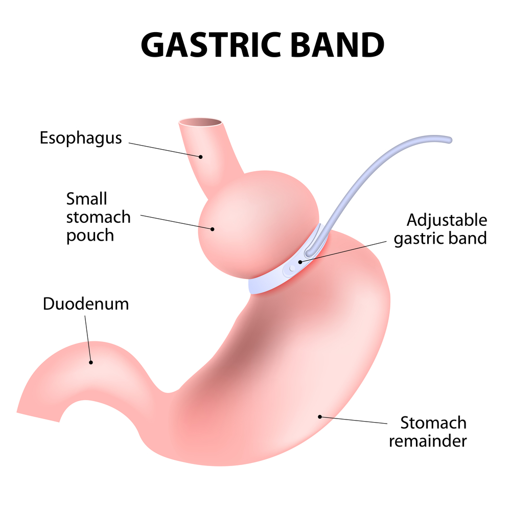 Gastric band surgery: benefits, risks and precautions 1 Gastric band surgery