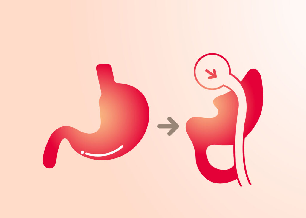 Gastric bypass surgery (roux-en-y) 4 Gastric bypass surgery (roux-en-y gastric bypass)