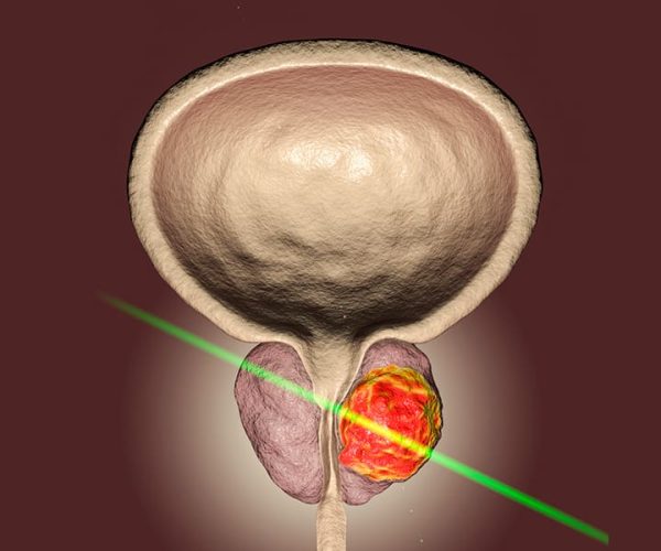 GreenLight Laser Therapy GreenLight Laser Therapy