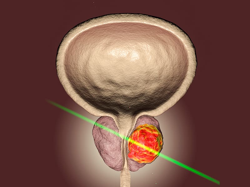 Greenlight laser therapy