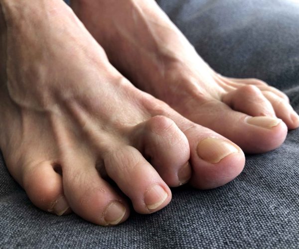 Straightening of curled toes to relieve pain and improve alignment.