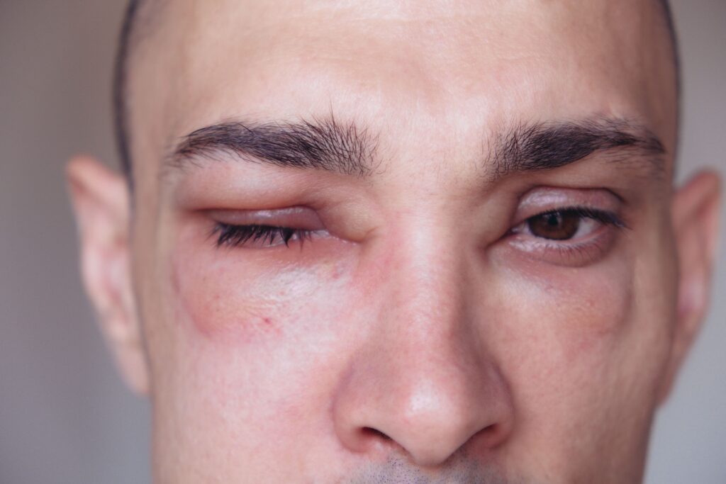 Insect allergies venom