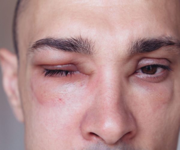 Insect Allergies (Venom) Insect Allergies (Venom)