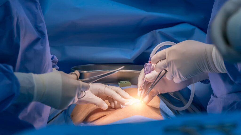 Laparoscopic surgery