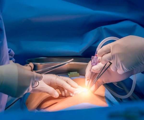 laparoscopy