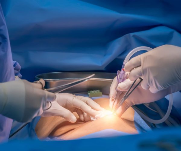 Laparoscopic Surgery Laparoscopic Surgery