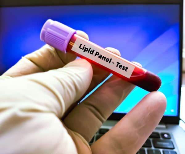 Blood Sample For Lipid Panel Test. Lipid Panel
