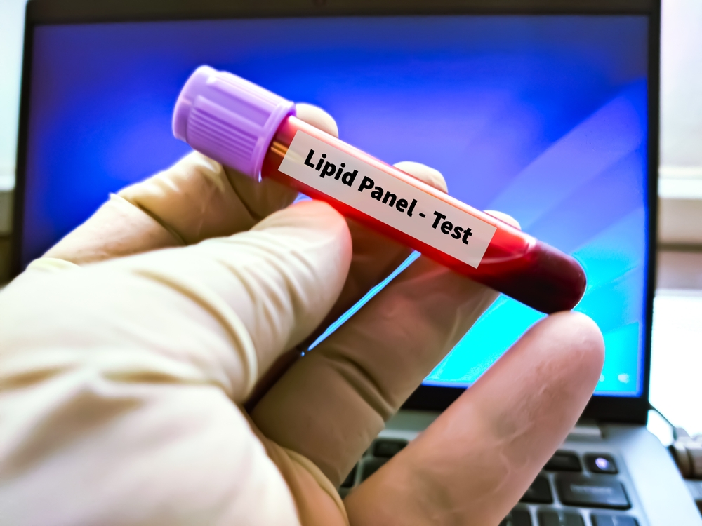 Lipid panel 3 Lipid panel