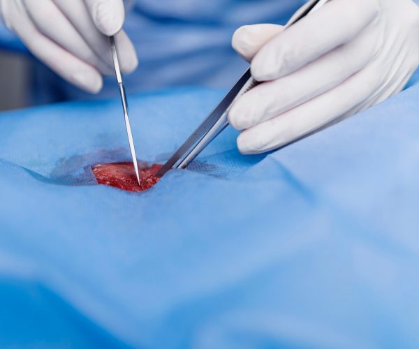 Percutaneous Native Kidney Biopsy Percutaneous Native Kidney Biopsy