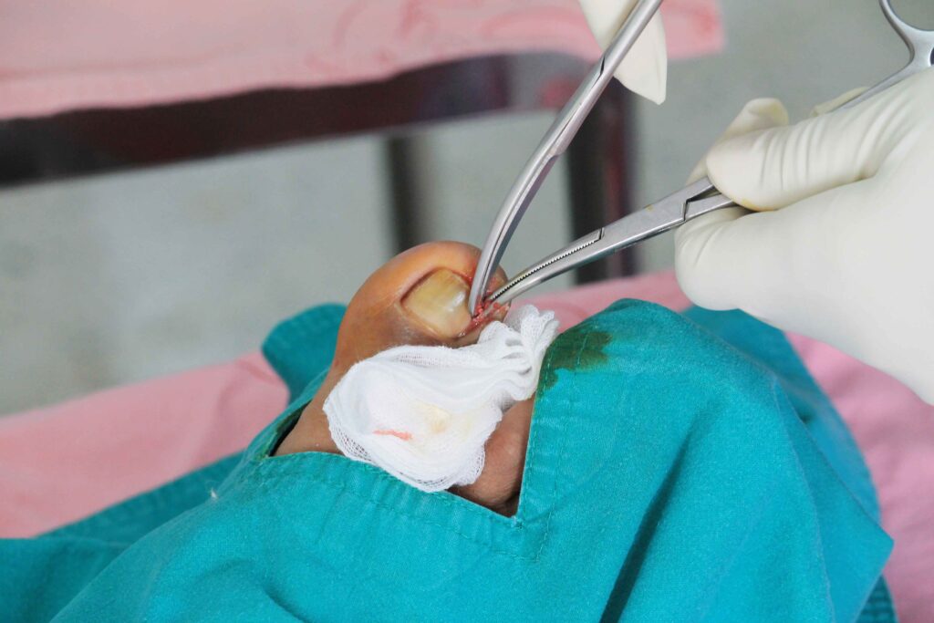 Nail excision (partial/total nail avulsion) 6 Removal of part or all of a toenail to relieve pain or infection.