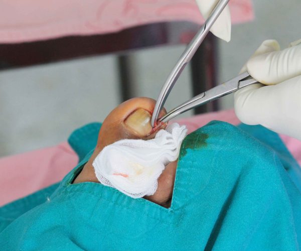 Removal of part or all of a toenail to relieve pain or infection.