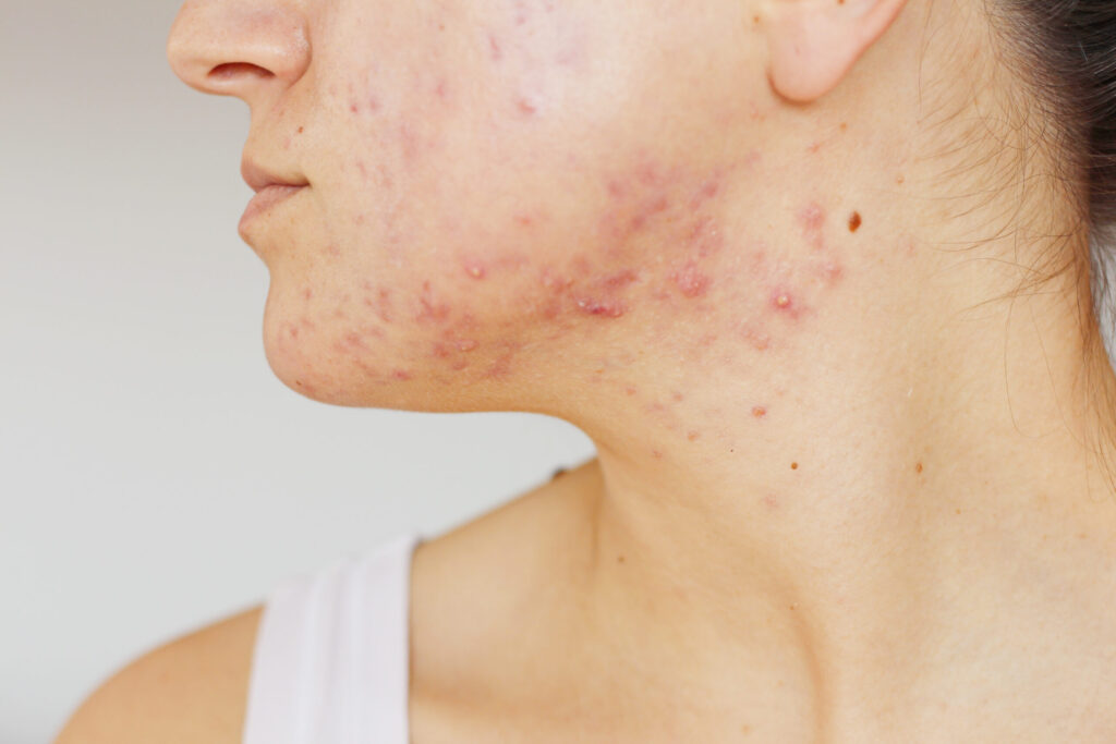 Severe acne