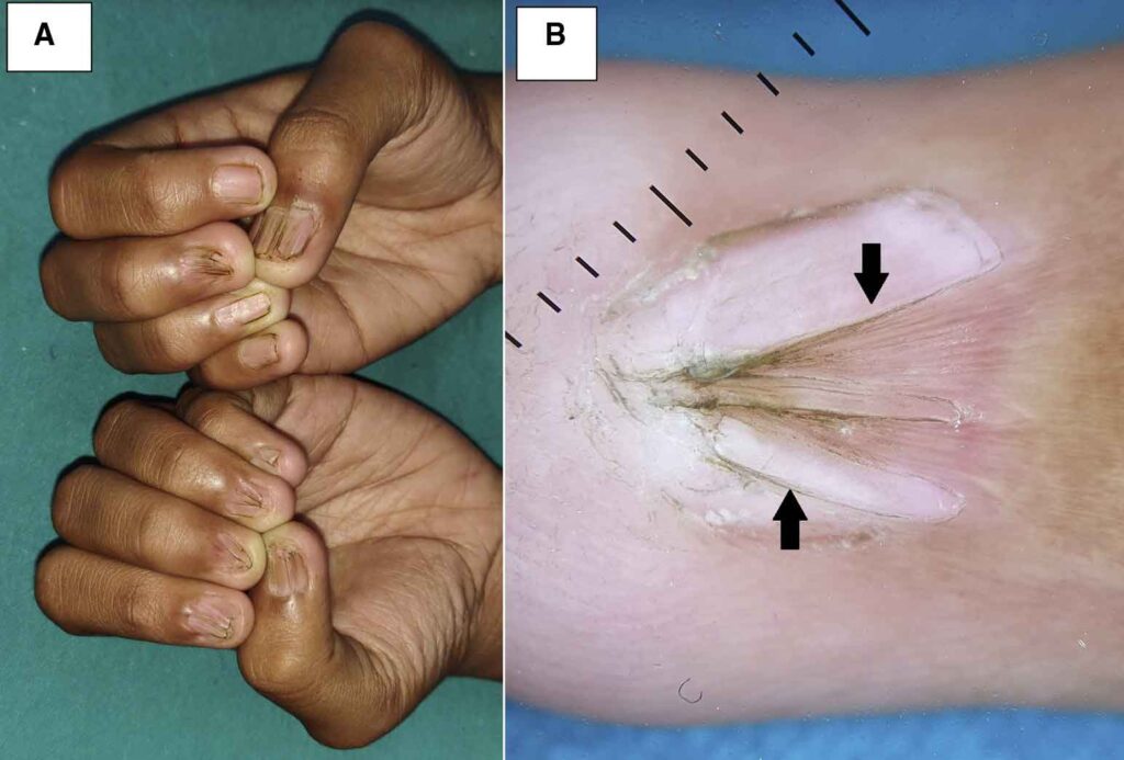 Surgical correction of pterygium unguis—skin overgrowth onto the nail plate.