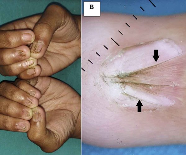 Pterygium Surgery (Nail Pterygium Release)