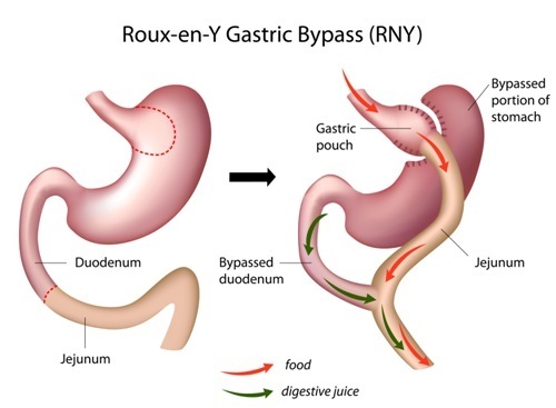 Roux-en-Y bypass surgery