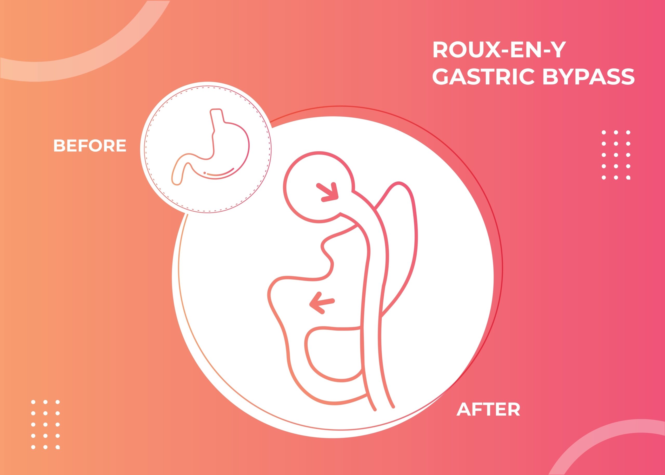 Roux-en-Y gastric bypass surgery