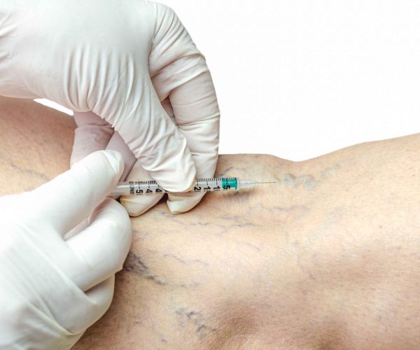 Sclerotherapy A minimally invasive treatment to reduce spider veins and small varicose veins. Sclerotherapy