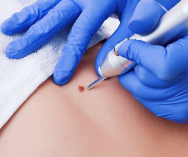 Lesion Removal Lesion Removal