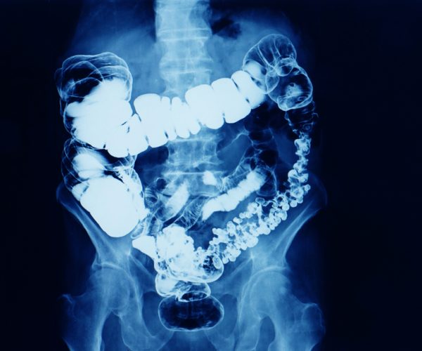 Barium Enema Barium Enema