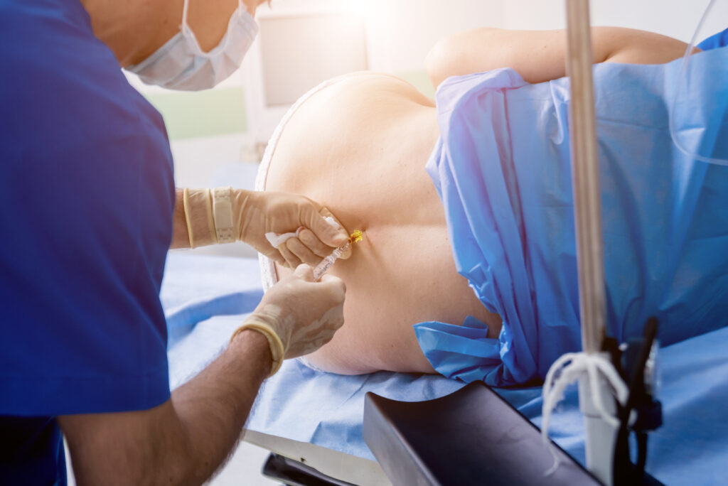 Epidural injections 4 Epidural injections