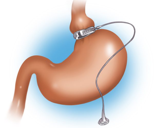 Gastric Banding Gastric Banding