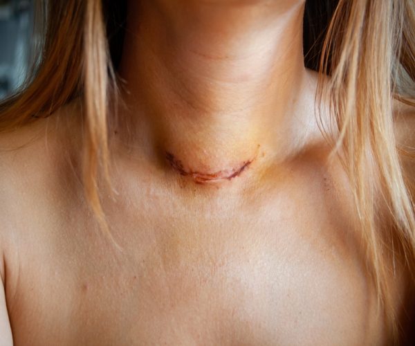 Endoscopic Thyroidectomy Endoscopic Thyroidectomy