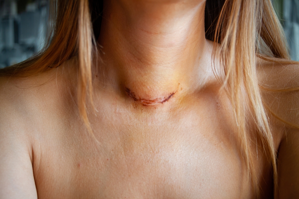 Endoscopic thyroidectomy