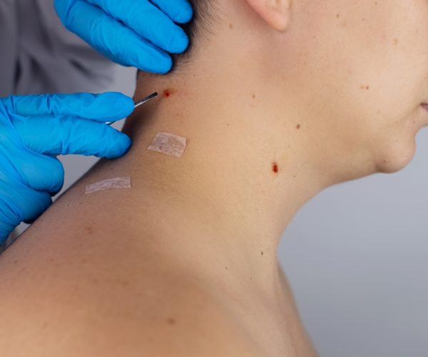 Excision Lesion Excision Lesion