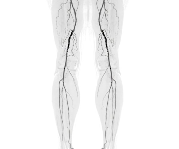 Peripheral Artery Disease (PAD) Treatment Peripheral Artery Disease (PAD) Treatment