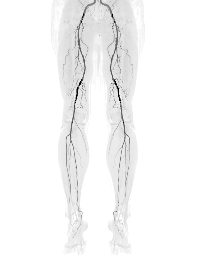 Peripheral artery disease (pad) treatment