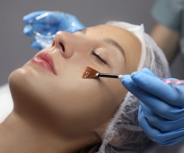 Chemical Peels