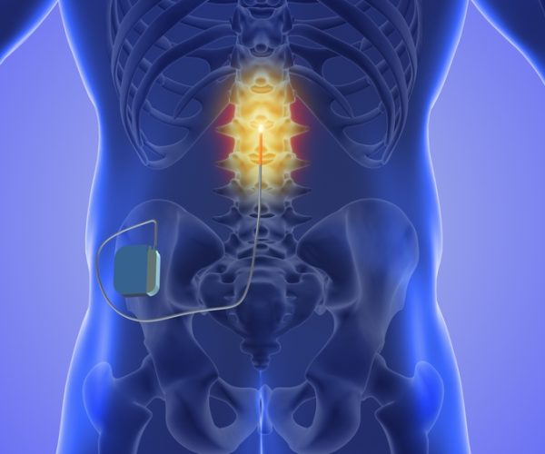 Spinal Cord Stimulation Injecting,Steroids,To,Treat,Herniated,Disc,Pain,3d,Illustration