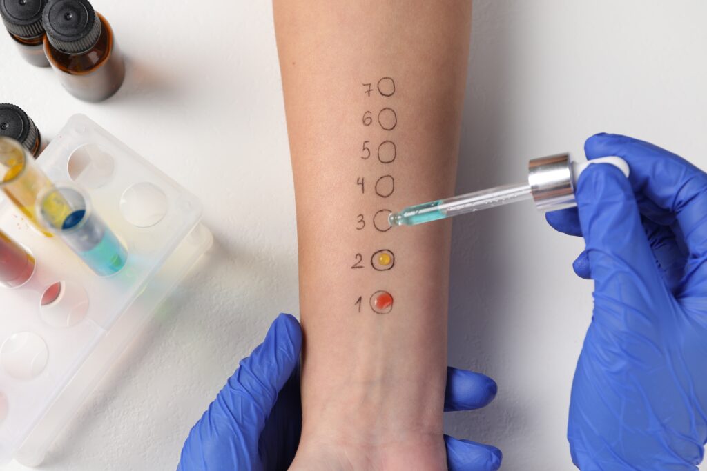Skin allergy test: what to expect and how they work 1 Skin allergy test