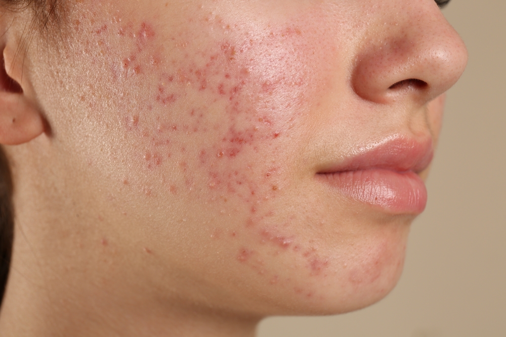 Hormonal Acne