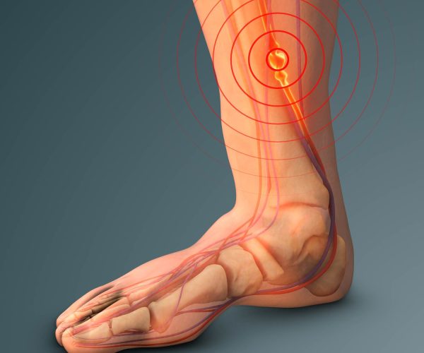 Deep Vein Thrombosis (DVT) Treatment