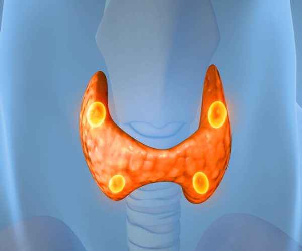 Minimally Invasive Parathyroidectomy (MIP)