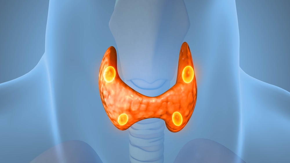 Minimally invasive parathyroidectomy (mip)