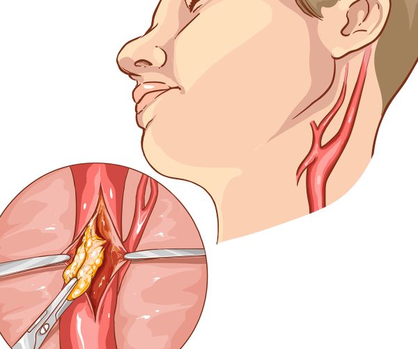 Carotid Endarterectomy